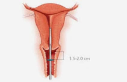 While holding the slider in the furthest position, advance the inserter through the cervix until the flange is approx. 1.5 - 2.0 cm from the uterine cervix.