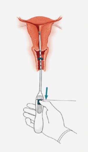 While holding the inserter steady, pull the slider to the mark to open the horizontal arms of the LNG-IUS. Wait 5-10 seconds for the horizontal arms to open completely.