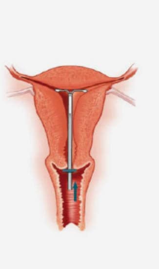 Advance the inserter gently towards the fundus of the uterus until the flange touches the cervix. The LNG-IUS is now in the fundal position.